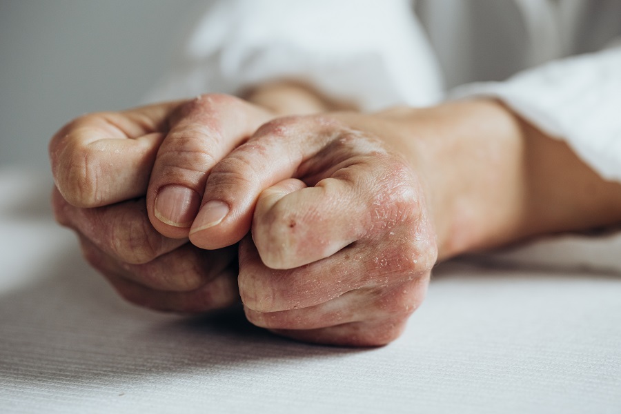 آرتریت پسوریاتیک