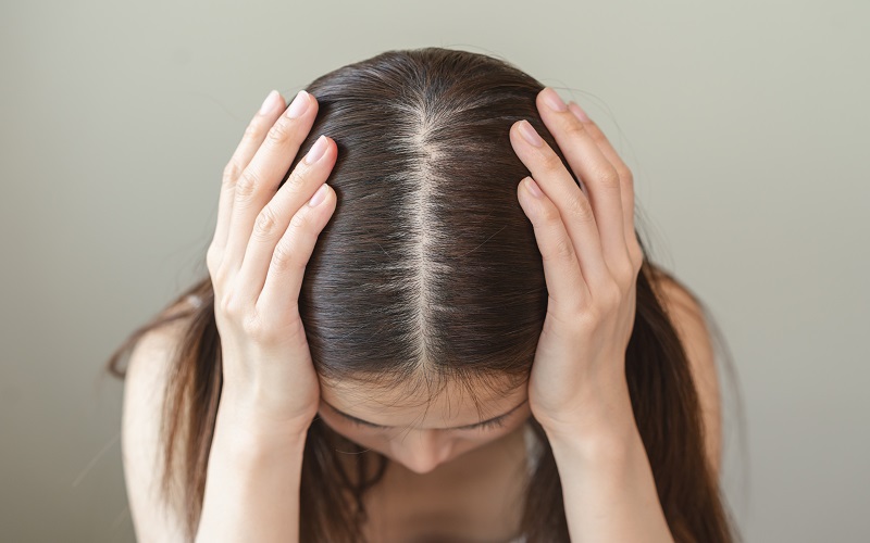 ریزش مو بر اثر پسوریازیس