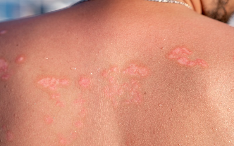 پسوریازیس و نور خورشید