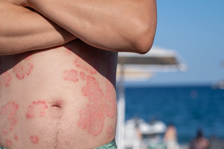 نور آفتاب و پسوریازیس